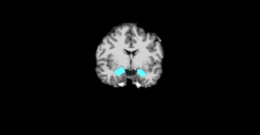 A black and white scan of a brain. Two small sections of the brain are highlighted in blue.